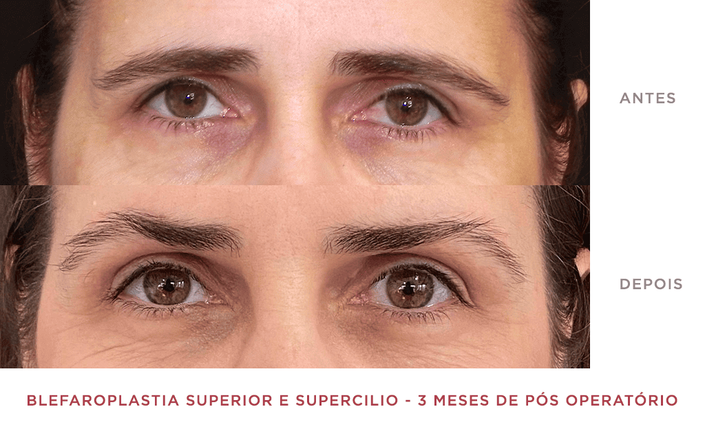 Blefaroplastia Superior E Supercilio 3 Meses De Pós Operatório 01