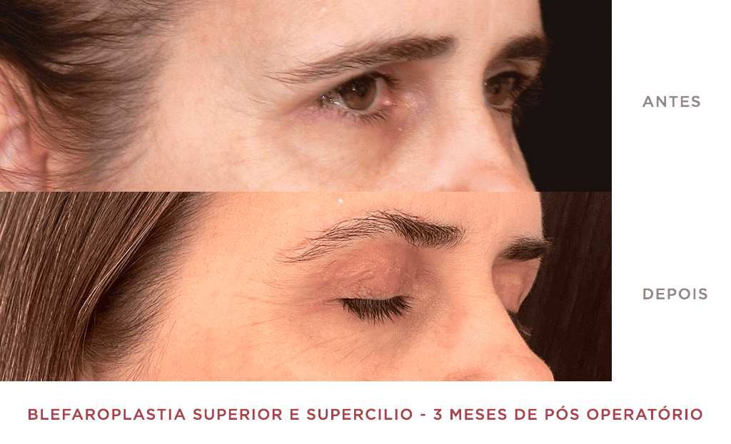 Blefaroplastia Superior E Supercilio 3 Meses De Pós Operatório 02