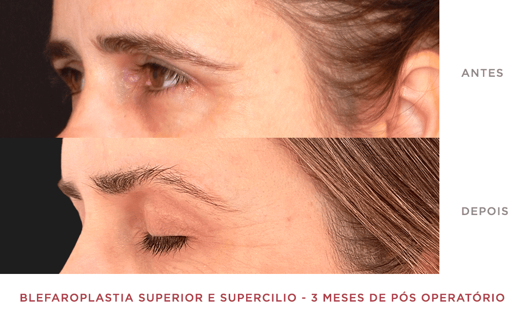 Blefaroplastia Superior E Supercilio 3 Meses De Pós Operatório 03