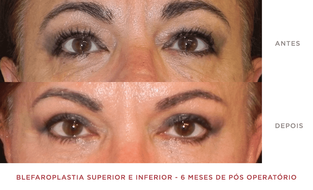 Blefaroplastia Superior E Inferior 02
