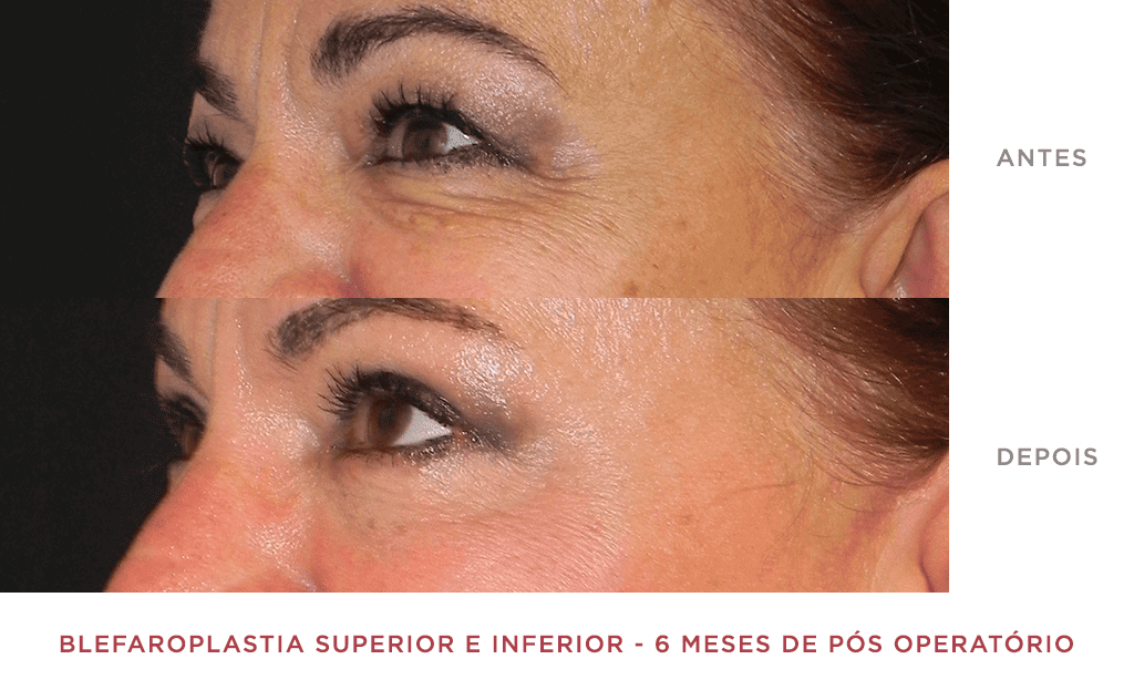 Blefaroplastia Superior E Inferior 03