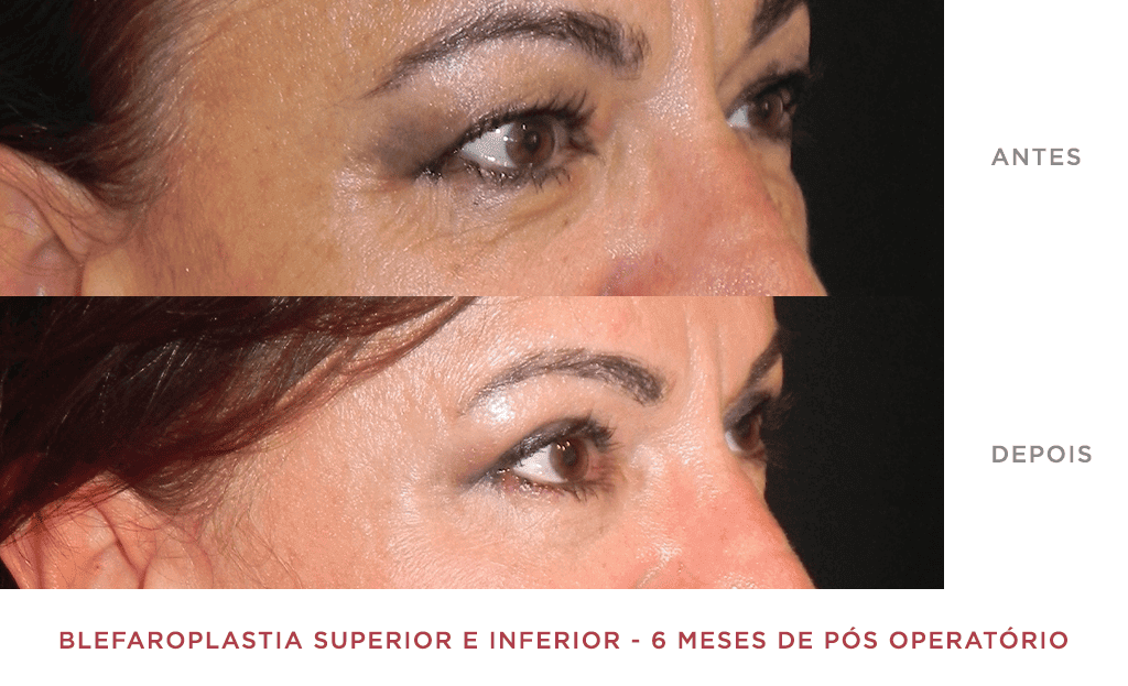 Blefaroplastia Superior E Inferior 04