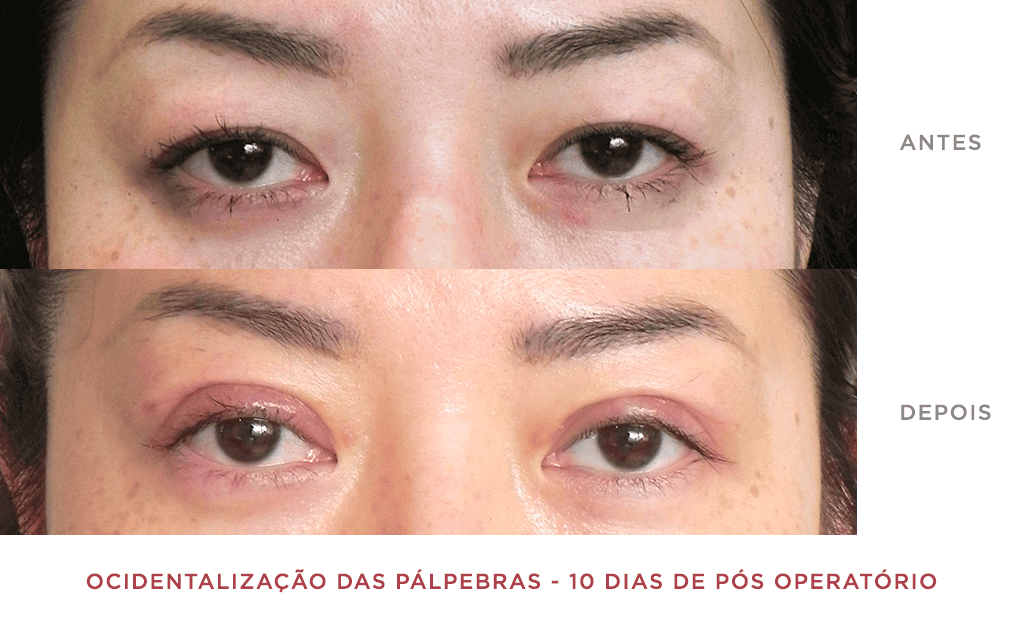 Ocidentalização Das Pálpebras 10 Dias De Pós Operatório 01