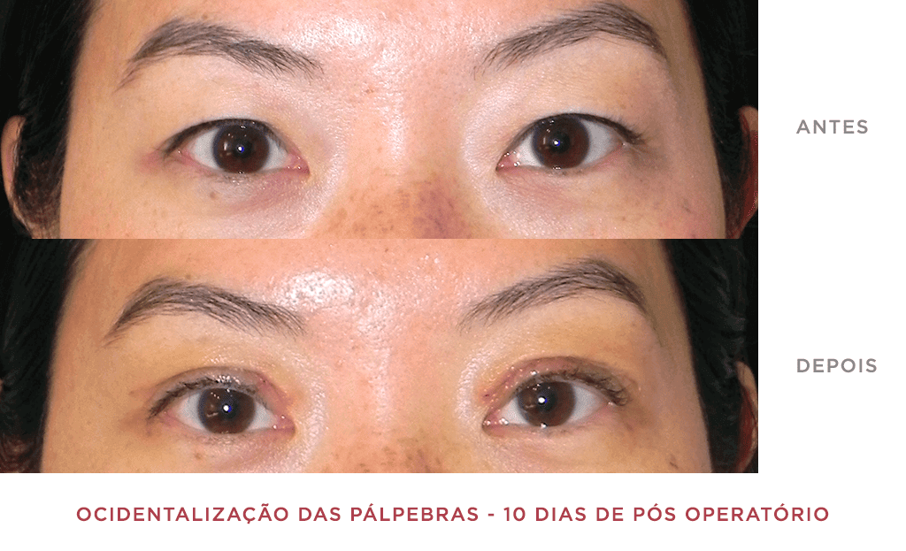 Ocidentalização Das Pálpebras 10 Dias De Pós Operatório 02