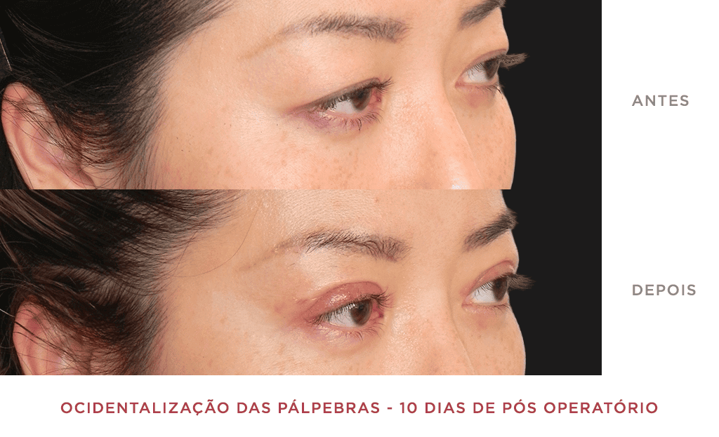 Ocidentalização Das Pálpebras 10 Dias De Pós Operatório 04