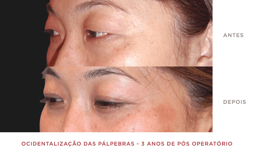 Ocidentalização Das Pálpebras 3 Anos De Pós Operatório 01