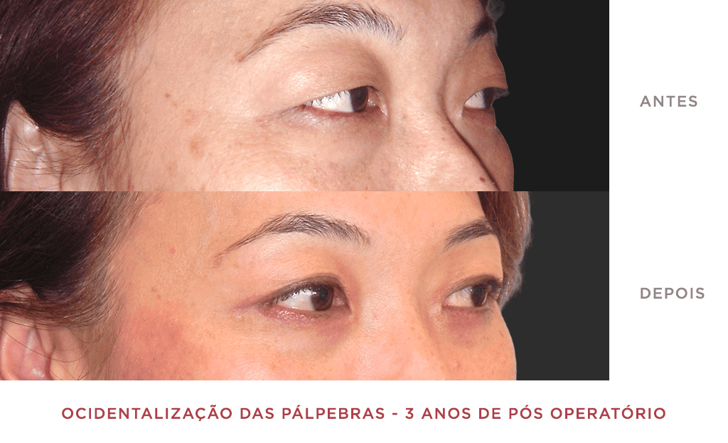Ocidentalização Das Pálpebras 3 Anos De Pós Operatório 02