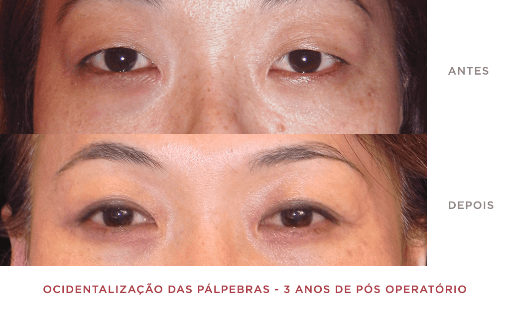 Ocidentalização Das Pálpebras 3 Anos De Pós Operatório 03