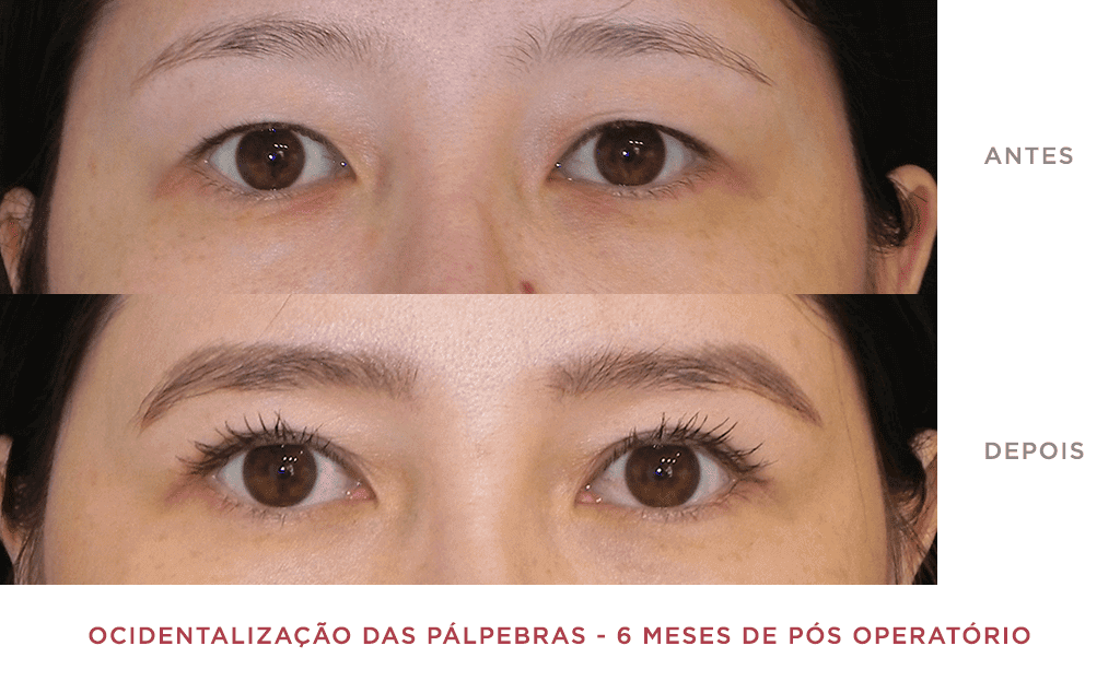 Ocidentalização Das Pálpebras 6 Meses De Pós Operatório 01
