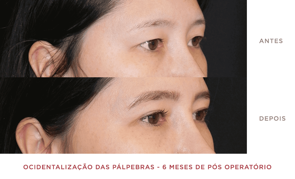 Ocidentalização Das Pálpebras 6 Meses De Pós Operatório 02