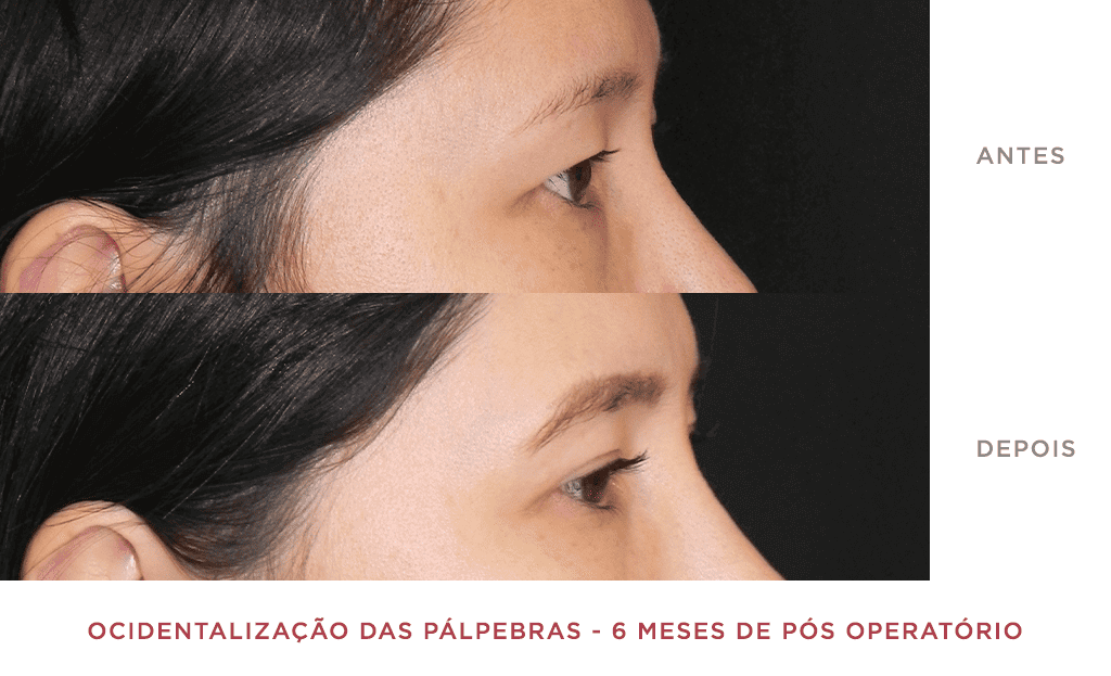 Ocidentalização Das Pálpebras 6 Meses De Pós Operatório 03