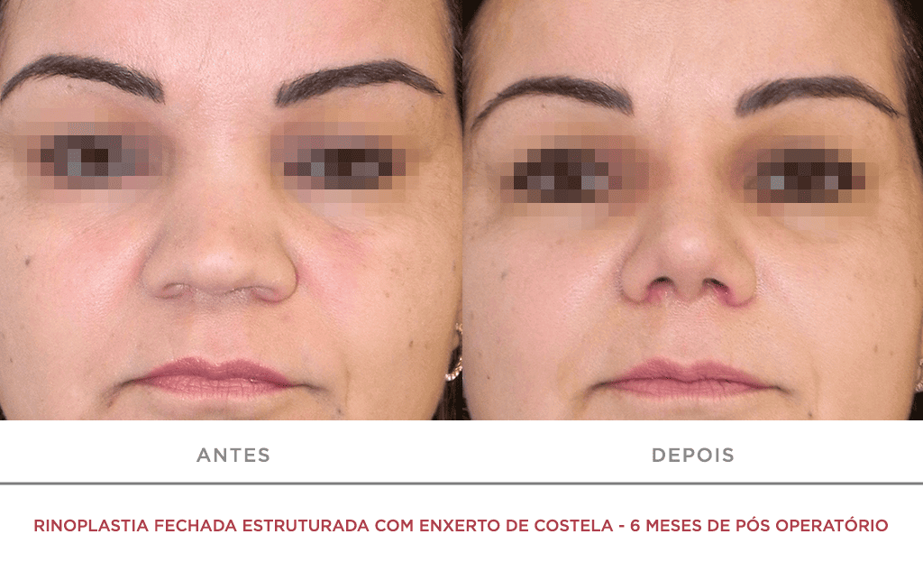 Rinoplastia Fechada Estruturada Com Enxerto De Costela 6 Meses De Pós Operatório 01f