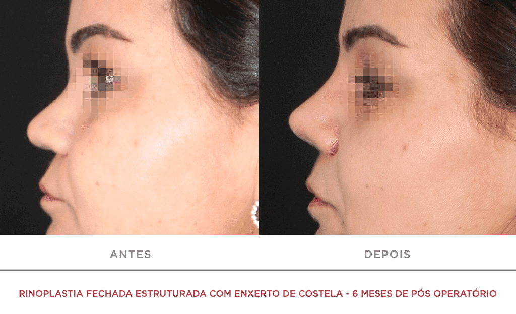 Rinoplastia Fechada Estruturada Com Enxerto De Costela 6 Meses De Pós Operatório 02f