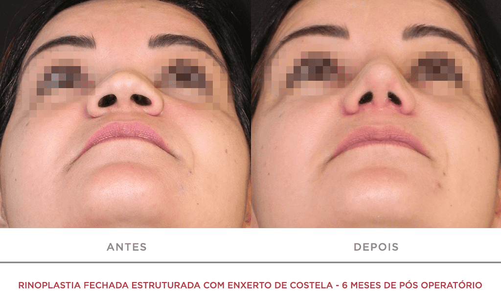 Rinoplastia Fechada Estruturada Com Enxerto De Costela 6 Meses De Pós Operatório 03f