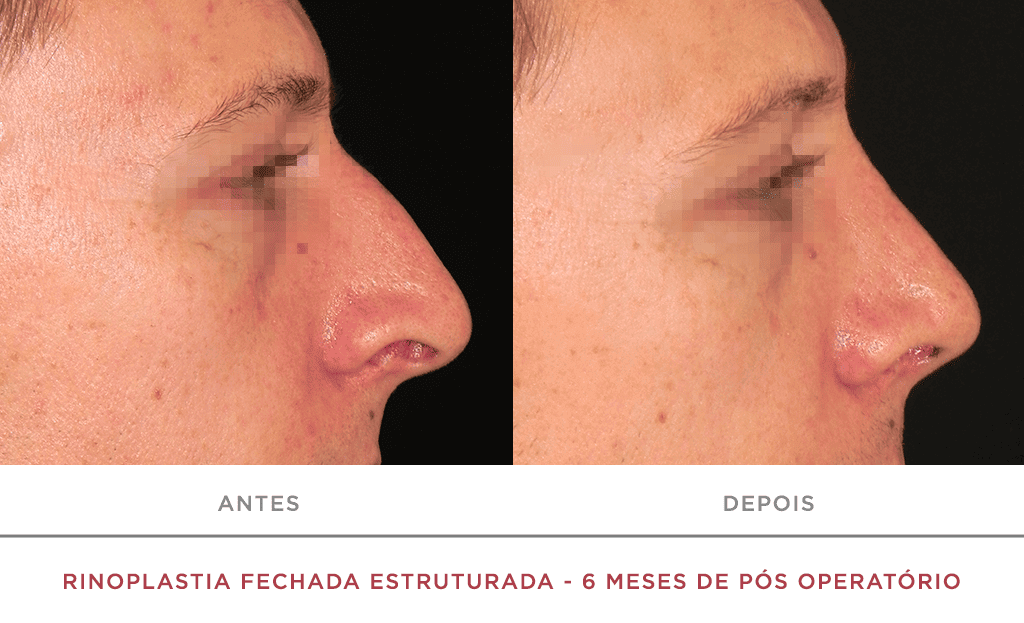 Rinoplastia Fechada Estruturada 6 Meses De Pós Operatório 01