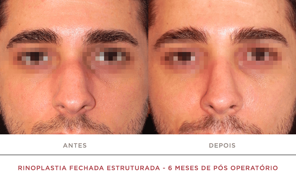 Rinoplastia Fechada Estruturada 6 Meses De Pós Operatório 02