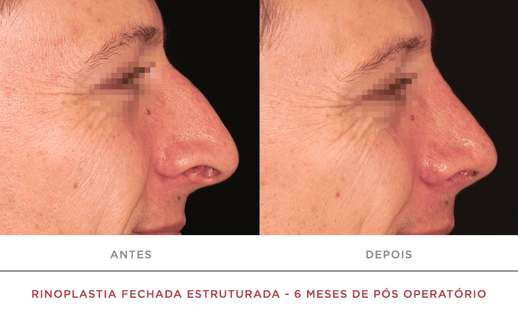 Rinoplastia Fechada Estruturada 6 Meses De Pós Operatório 03