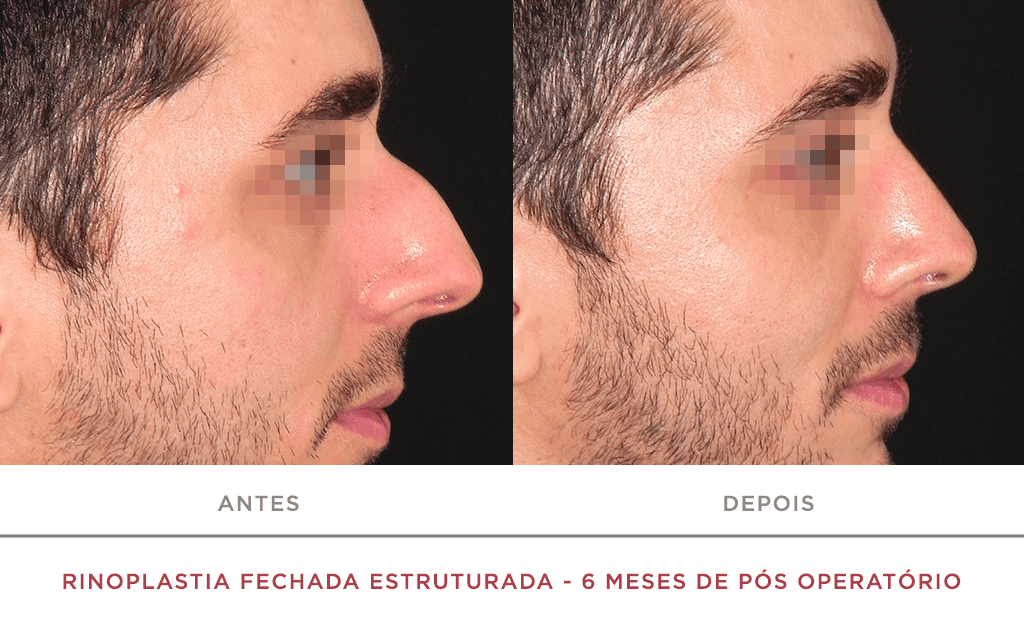 Rinoplastia Fechada Estruturada 6 Meses De Pós Operatório 04