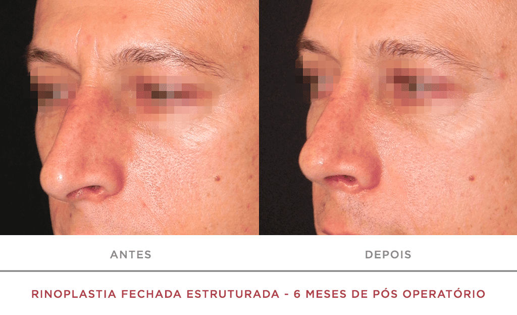 Rinoplastia Fechada Estruturada 6 Meses De Pós Operatório 05