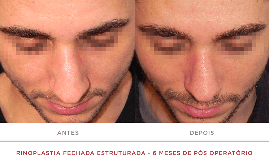 Rinoplastia Fechada Estruturada 6 Meses De Pós Operatório 08
