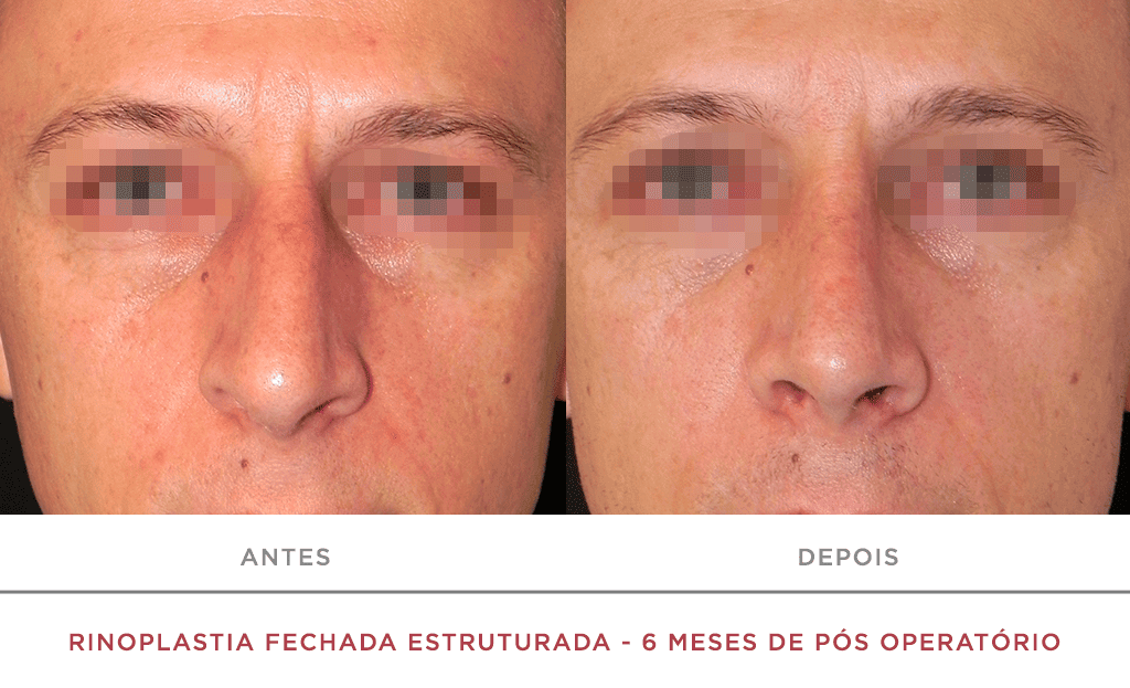 Rinoplastia Fechada Estruturada 6 Meses De Pós Operatório 09