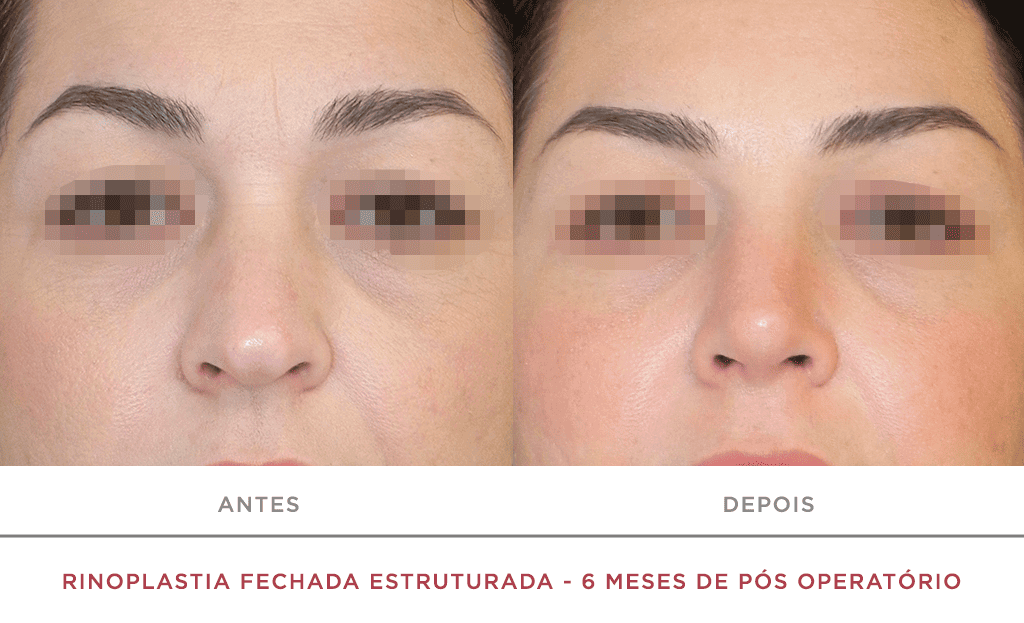 Rinoplastia Fechada Estruturada 6 Meses De Pós Operatório 01f