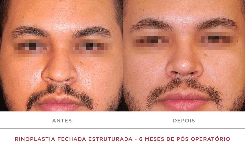 Rinoplastia Fechada Estruturada 6 Meses De Pós Operatório 01n