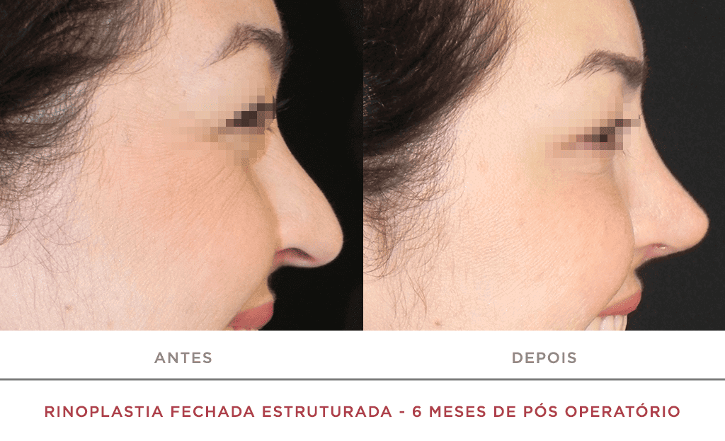 Rinoplastia Fechada Estruturada 6 Meses De Pós Operatório 02f