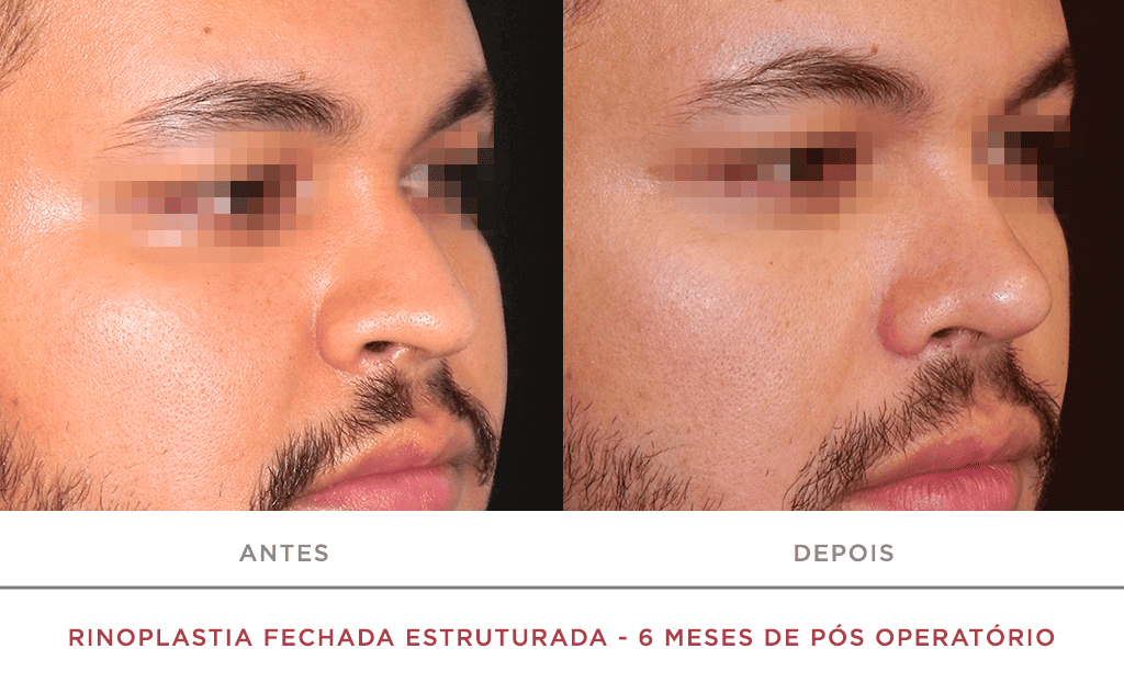 Rinoplastia Fechada Estruturada 6 Meses De Pós Operatório 02n