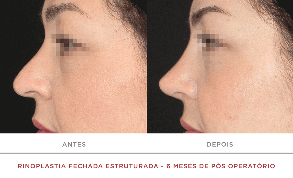 Rinoplastia Fechada Estruturada 6 Meses De Pós Operatório 03f