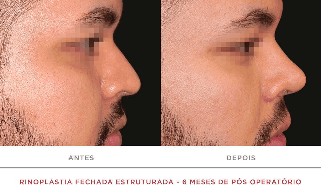 Rinoplastia Fechada Estruturada 6 Meses De Pós Operatório 03n