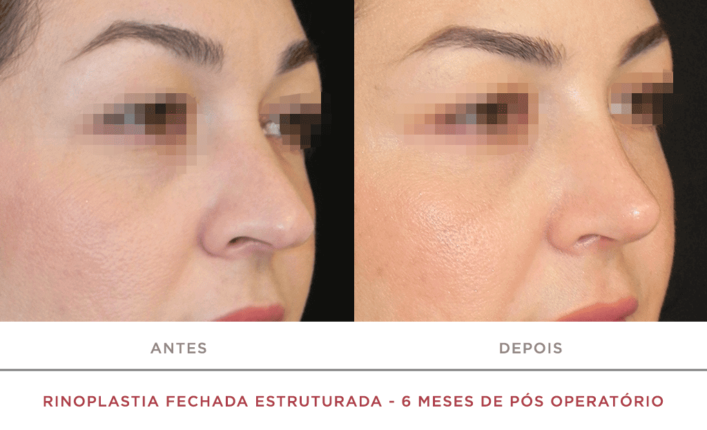 Rinoplastia Fechada Estruturada 6 Meses De Pós Operatório 04f